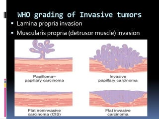 WHO grading of Invasive tumors 
 Lamina propria invasion 
 Muscularis propria (detrusor muscle) invasion 
 