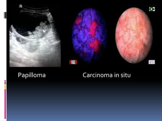 Papilloma Carcinoma in situ 
 