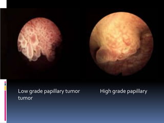 Low grade papillary tumor High grade papillary 
tumor 
 