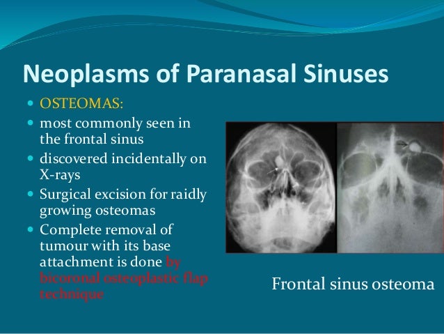 characteristics of fibrous dysplasia a rare bone disease Fibrous dyspasia is a disease that causes bone thinning and growths or lesions in one or more bones, and leads to bone weakness and scar formation within the bones these lesions are tumor-like growths that consist of replacement of the medullary bone with fibrous tissue, causing the expansion and weakening of the areas of bone involved. characteristics of fibrous dysplasia a rare bone disease Fibrous dyspasia is a disease that causes bone thinning and growths or lesions in one or more bones, and leads to bone weakness and scar formation within the bones these lesions are tumor-like growths that consist of replacement of the medullary bone with fibrous tissue, causing the expansion and weakening of the areas of bone involved.