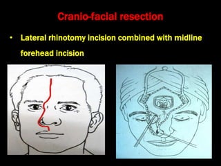 Total Rhinotomy Neoplasms of nose and paranasal sinuses | PPT