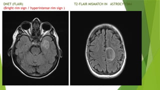 Neoplastic brain tumors in children.pptx