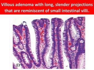 Villous adenoma with long, slender projections
that are reminiscent of small intestinal villi .

 