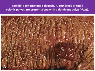Familial adenomatous polyposis. A, Hundreds of small
colonic polyps are present along with a dominant polyp (right).

 