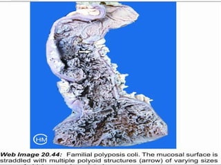 Neoplastic Colonic polyps- Colonic Adenoma; Familial Syndromes