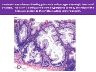 Neoplastic Colonic polyps- Colonic Adenoma; Familial Syndromes | PPT