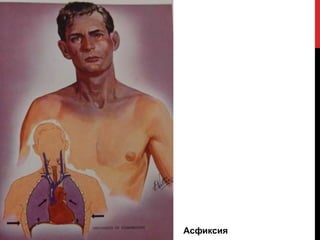 Асфиксия
 