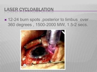 LASER CYCLOABLATION


12-24 burn spots ,posterior to limbus over
360 degrees , 1500-2000 MW, 1.5-2 secs.

 