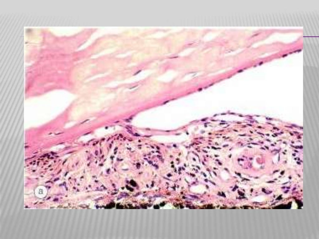 Neovascular glaucoma