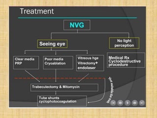 Neovascular glaucoma