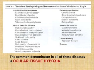 The common denominator in all of these diseases
is OCULAR TISSUE HYPOXIA.
 