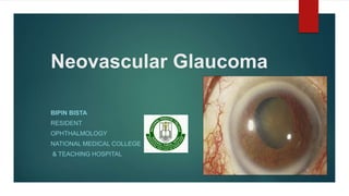 Neovascular Glaucoma
BIPIN BISTA
RESIDENT
OPHTHALMOLOGY
NATIONAL MEDICAL COLLEGE
& TEACHING HOSPITAL
 