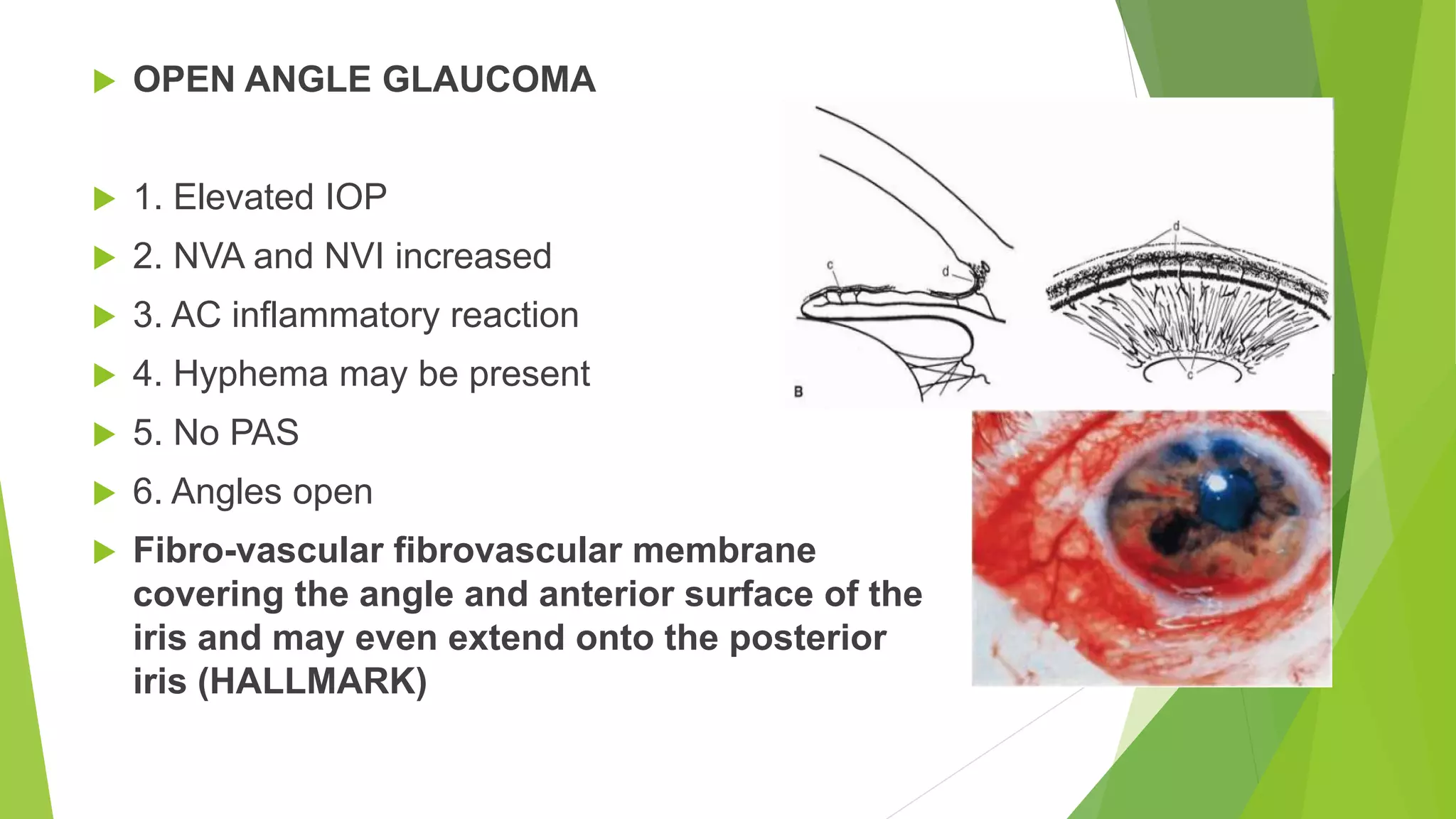  OPEN ANGLE GLAUCOMA
 1. Elevated IOP
 2. NVA and NVI increased
 3. AC inflammatory reaction
 4. Hyphema may be present
 5. No PAS
 6. Angles open
 Fibro-vascular fibrovascular membrane
covering the angle and anterior surface of the
iris and may even extend onto the posterior
iris (HALLMARK)
 