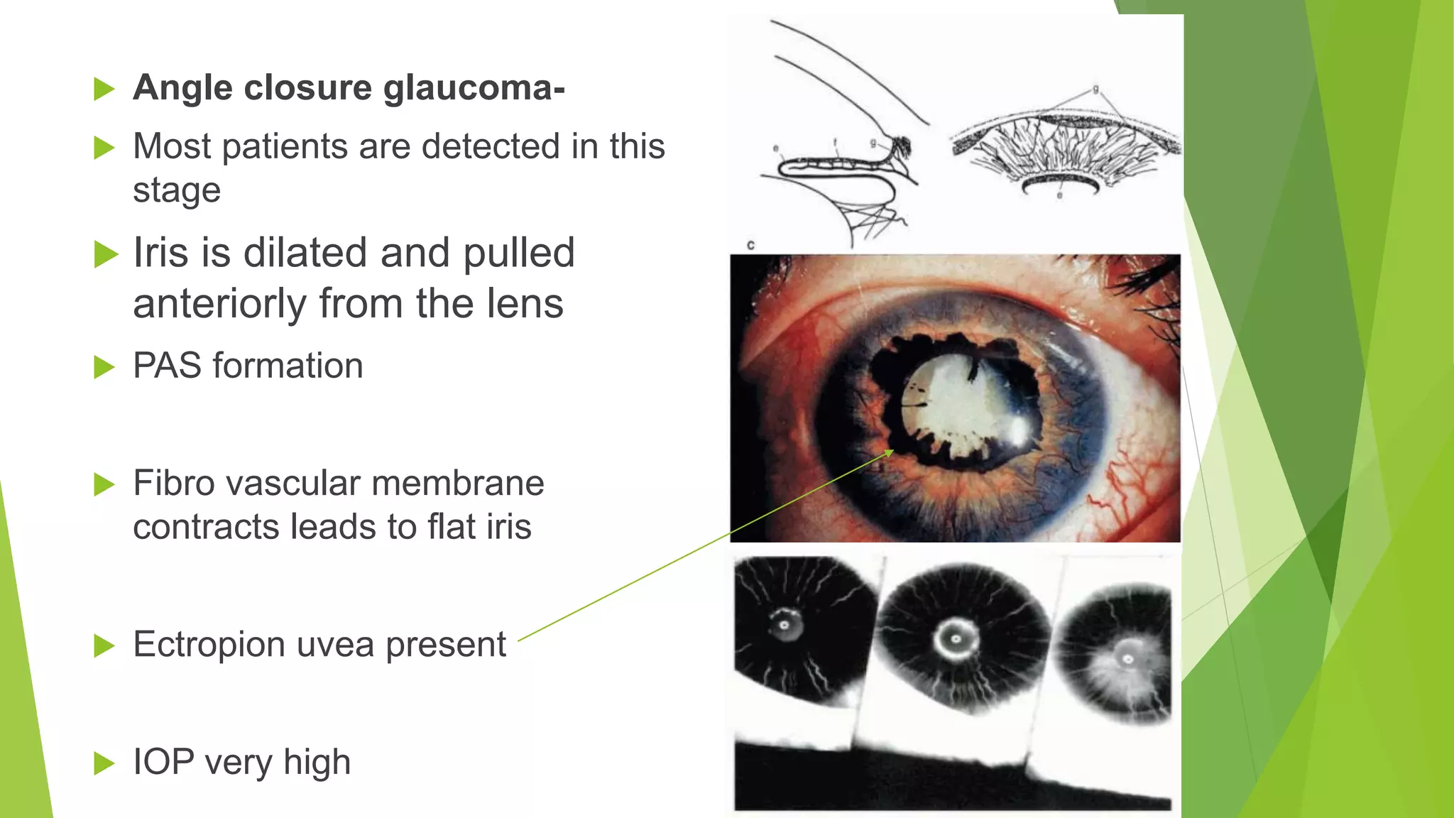  Angle closure glaucoma-
 Most patients are detected in this
stage
 Iris is dilated and pulled
anteriorly from the lens
 PAS formation
 Fibro vascular membrane
contracts leads to flat iris
 Ectropion uvea present
 IOP very high
 