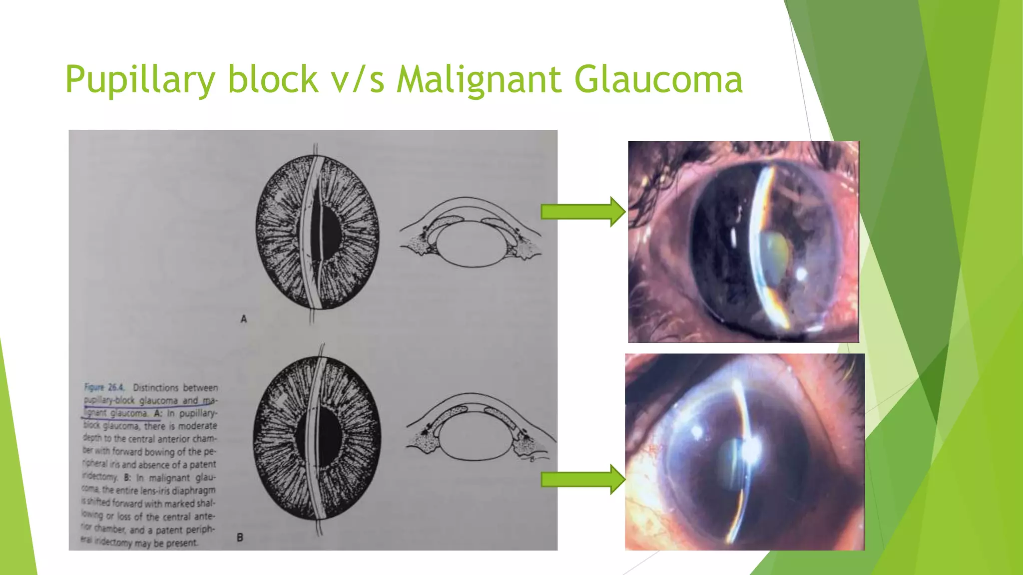 Pupillary block v/s Malignant Glaucoma
 