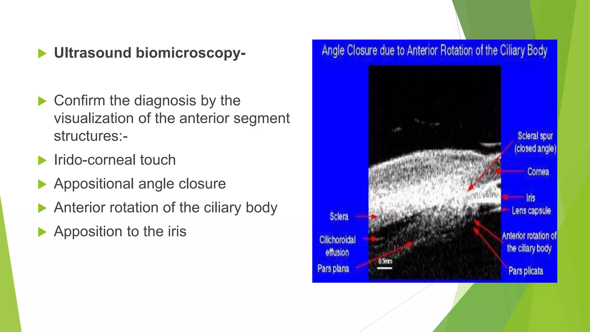  Ultrasound biomicroscopy-
 Confirm the diagnosis by the
visualization of the anterior segment
structures:-
 Irido-corneal touch
 Appositional angle closure
 Anterior rotation of the ciliary body
 Apposition to the iris
 