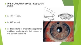 Negative Rubeosis Neovascular glaucoma (NVG) | PPTX