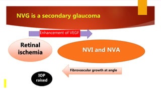 NVG is a secondary glaucoma
Retinal
ischemia NVI and NVA
Enhancement of VEGF
Fibrovascular growth at angle
IOP
raised
 