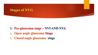 Stages of NVG
1. Pre-glaucoma stage – NVI AND NVA
2. Open angle glaucoma Stage
3. Closed angle glaucoma stage
 