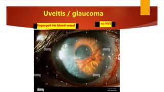 Uveitis / glaucoma
Engorged iris blood vessel
no NVI
 