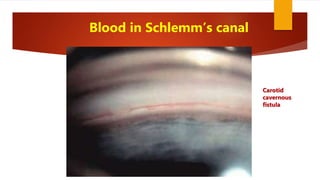 Blood in Schlemm’s canal
Carotid
cavernous
fistula
 