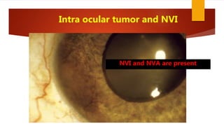 Intra ocular tumor and NVI
NVI and NVA are present
 