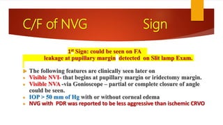 C/F of NVG Sign
1st Sign: could be seen on FA
leakage at pupillary margin detected on Slit lamp Exam.
 The following features are clinically seen later on
 Visible NVI- that begins at pupillary margin or iridectomy margin.
 Visible NVA -via Gonioscope – partial or complete closure of angle
could be seen.
 IOP > 50 mm of Hg with or without corneal edema
 NVG with PDR was reported to be less aggressive than ischemic CRVO
 