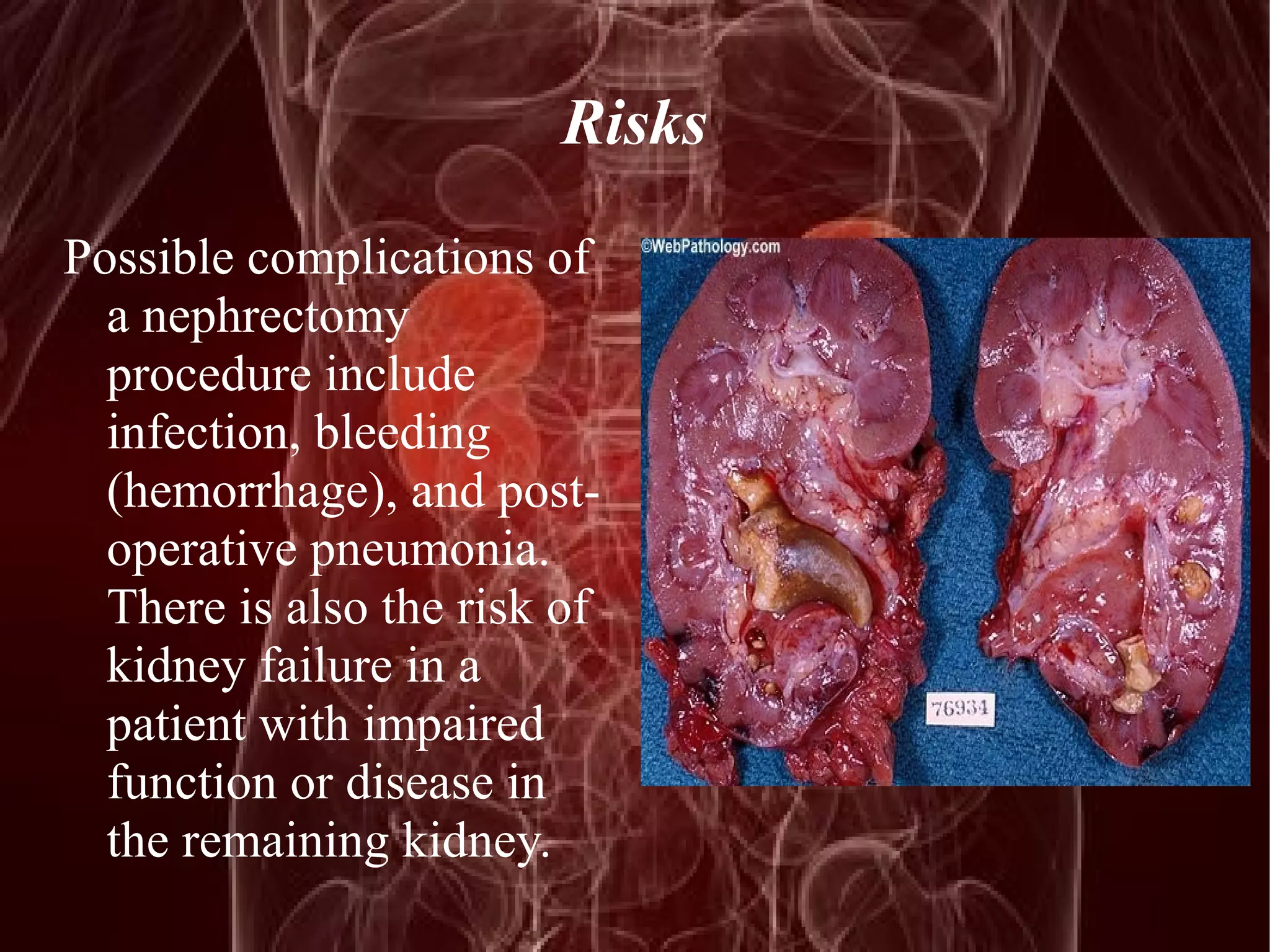 Risks 
Possible complications of 
a nephrectomy 
procedure include 
infection, bleeding 
(hemorrhage), and post-operative 
pneumonia. 
There is also the risk of 
kidney failure in a 
patient with impaired 
function or disease in 
the remaining kidney. 
 