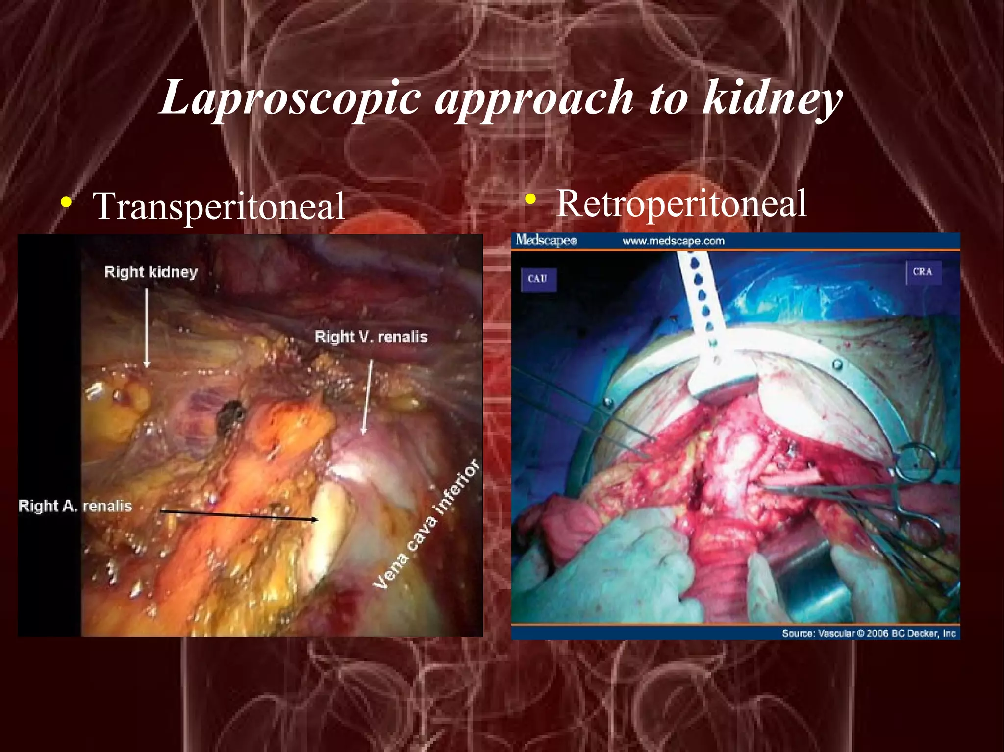 Laproscopic approach to kidney 
 Transperitoneal  Retroperitoneal 
 