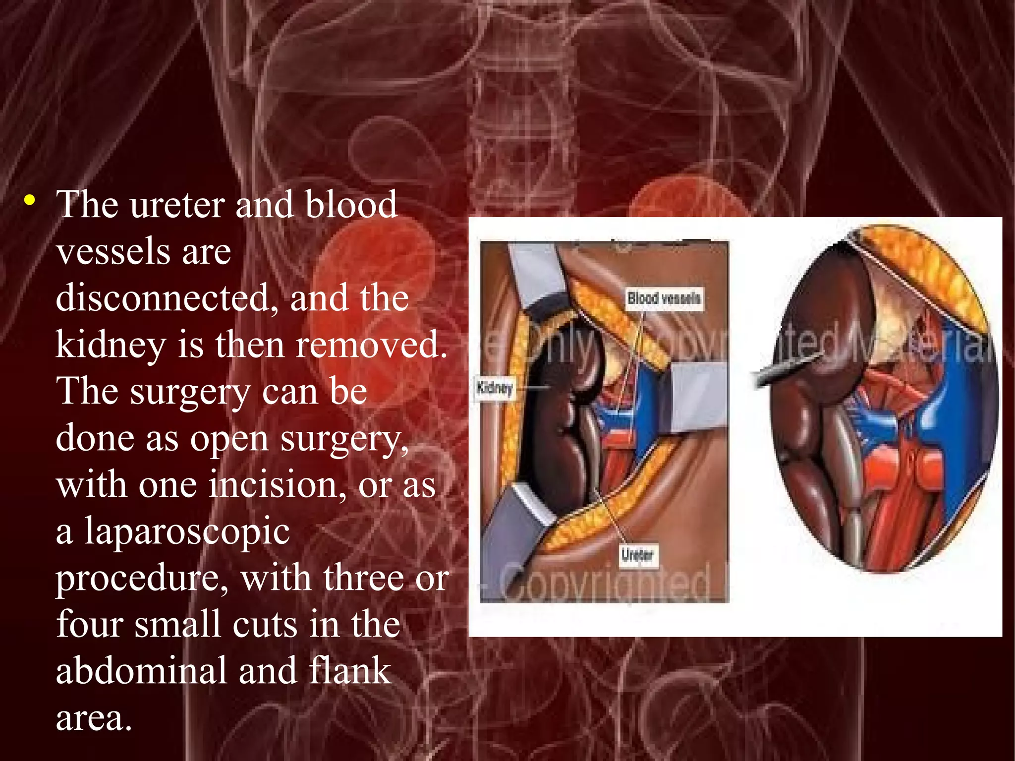  The ureter and blood 
vessels are 
disconnected, and the 
kidney is then removed. 
The surgery can be 
done as open surgery, 
with one incision, or as 
a laparoscopic 
procedure, with three or 
four small cuts in the 
abdominal and flank 
area. 
 