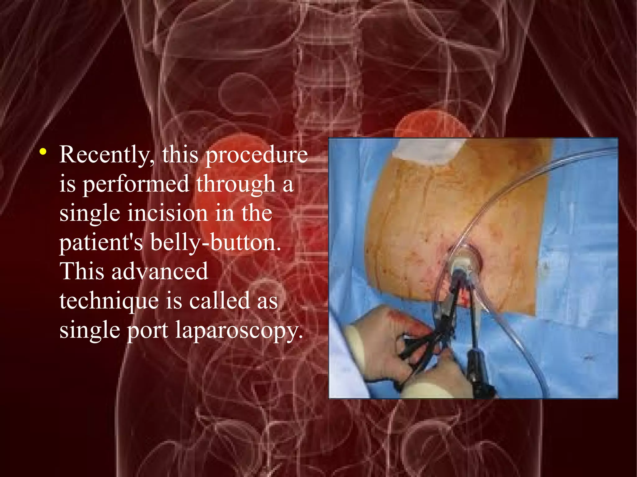  Recently, this procedure 
is performed through a 
single incision in the 
patient's belly-button. 
This advanced 
technique is called as 
single port laparoscopy. 
 