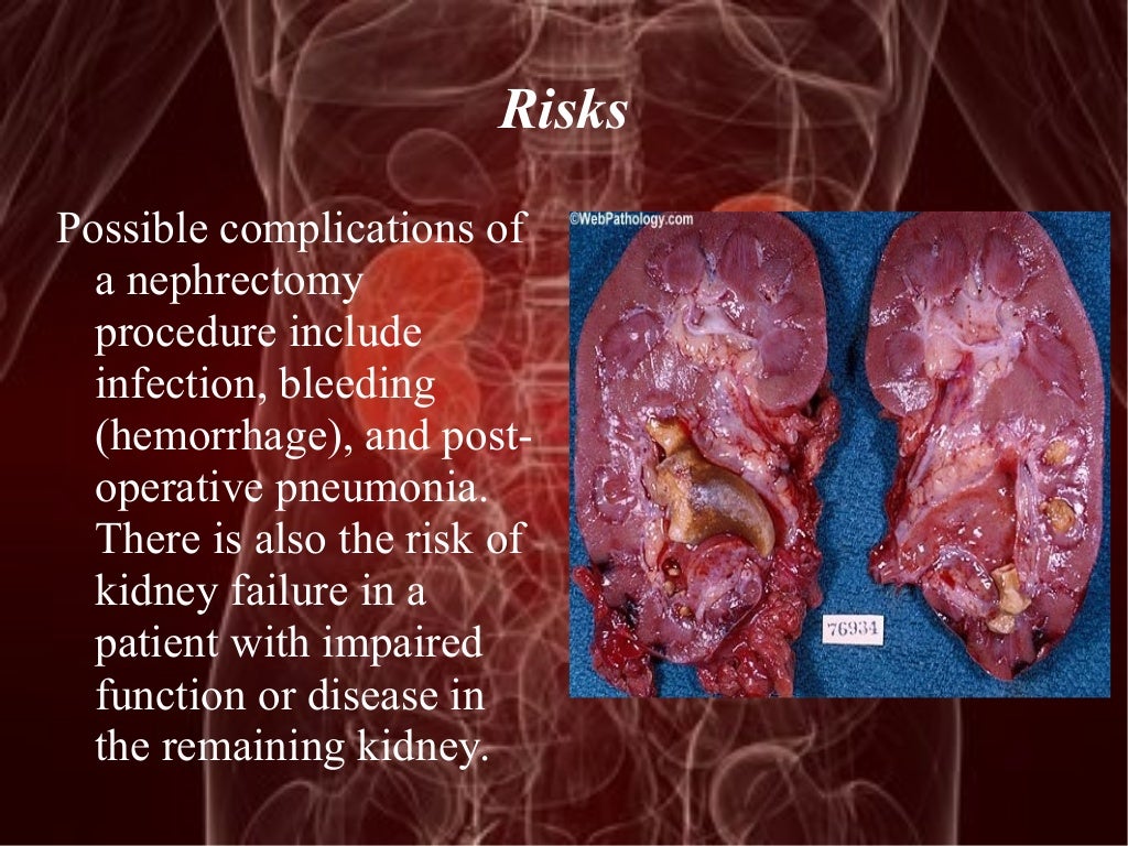 Nephrectomy