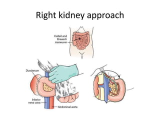 Right kidney approach
 