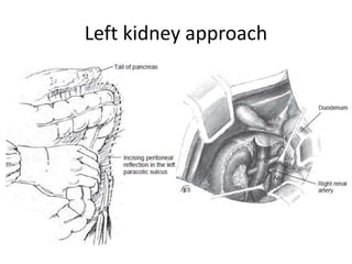 Left kidney approach
 