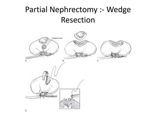 Partial Nephrectomy :- Wedge
Resection
 