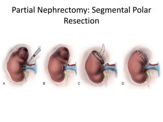 Partial Nephrectomy: Segmental Polar
Resection
 