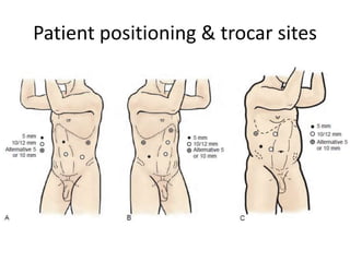 Patient positioning & trocar sites
 