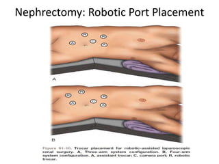Nephrectomy: Robotic Port Placement
 