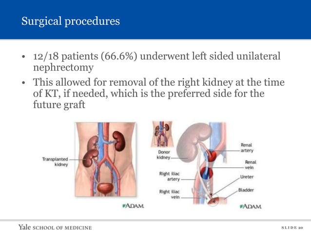 Journal Club. Native nephrectomy prior to pediatric kidney ...