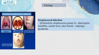 Nephritic syndrome in children mmmm.pptx