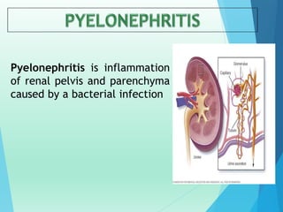 Pyelonephritis is inflammation
of renal pelvis and parenchyma
caused by a bacterial infection
 