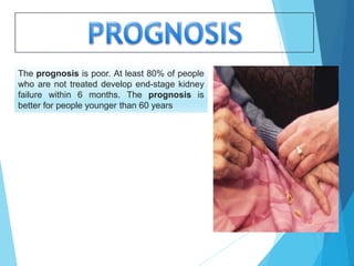 The prognosis is poor. At least 80% of people
who are not treated develop end-stage kidney
failure within 6 months. The prognosis is
better for people younger than 60 years
 
