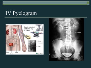 IV Pyelogram