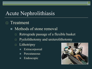 Acute NephrolithiasisTreatmentMethods of stone removalRetrograde passage of a flexible basketPyelolithotomy and ureterolithotomyLithotripsyExtracorporealPercutaneousEndoscopic 
