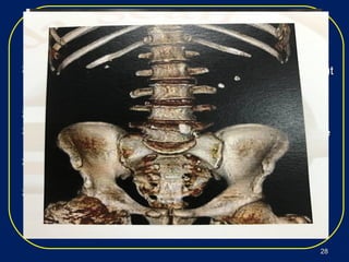 imagingimaging
modalitiesmodalities
 Spiral computed tomography (CT) of the abdomen withoutSpiral computed tomography (CT) of the abdomen without
intravenous contrast is the imaging modality of choice forintravenous contrast is the imaging modality of choice for
confirming nephrolithiasis.confirming nephrolithiasis.
 CT can detect stones as small as 1 mm in diameter.CT can detect stones as small as 1 mm in diameter.
 The sensitivity and specificity of noncontrast spiral CT areThe sensitivity and specificity of noncontrast spiral CT are
98% and 100%, respectively, for the diagnosis of stones.98% and 100%, respectively, for the diagnosis of stones.
 CT can detect radiolucent stones such as uric acid andCT can detect radiolucent stones such as uric acid and
indinavir stones.indinavir stones.
 CT provides information regarding location, size, numberCT provides information regarding location, size, number
of stones, and any structural abnormalities predisposingof stones, and any structural abnormalities predisposing
to stone formation.to stone formation.
2828
 
