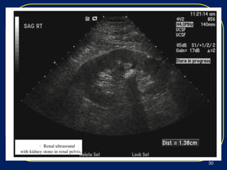 imagingimaging
modalitiesmodalities
 Ultrasound is inferior to CT for visualization of stones,Ultrasound is inferior to CT for visualization of stones,
compared to spiral CT as the gold standard .compared to spiral CT as the gold standard .
 Ultrasound can only image the kidney and proximalUltrasound can only image the kidney and proximal
ureter and may miss distal stones.ureter and may miss distal stones.
 Although a suboptimal imaging modality forAlthough a suboptimal imaging modality for
nephrolithiasis, ultrasound does not use radiation andnephrolithiasis, ultrasound does not use radiation and
should be used in cases where radiation isshould be used in cases where radiation is
contraindicated, such as pregnant patients.contraindicated, such as pregnant patients.
3030
 