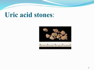 Uric acid stones:
16
 