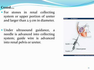 Contd….
 For stones in renal collecting
system or upper portion of ureter
and larger than 2.5 cm in diameter.
 Under ultrasound guidance, a
needle is advanced into collecting
system; guide wire is advanced
into renal pelvis or ureter.
33
 