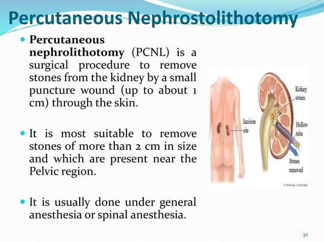 Nephrolithiasis