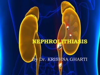 NEPHROLITHIASIS
By Dr. KRISHNA GHARTI
 